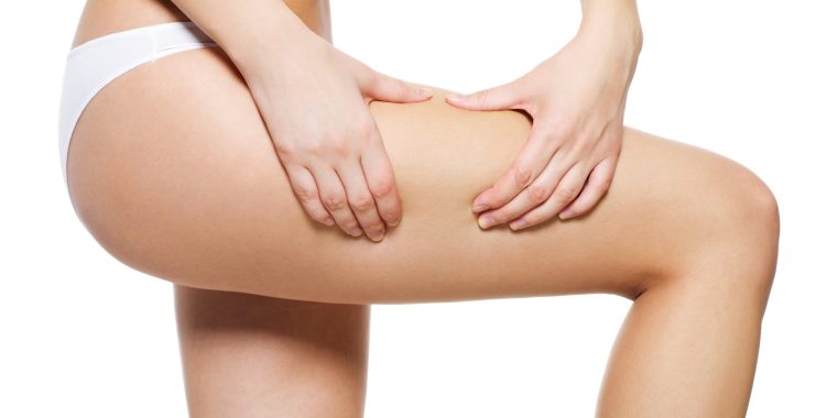 Female squeezes cellulite skin on her legs - close-up shot on white background
